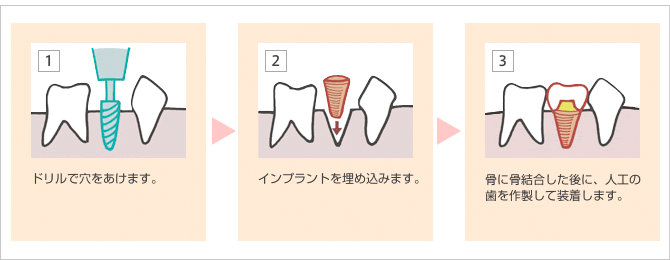 インプラント治療の手順