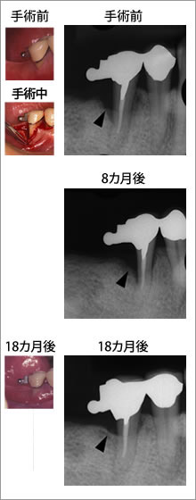 写真2●治療前と治療後のX線写真