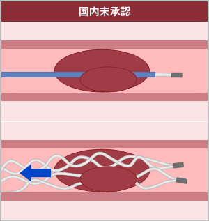 脳血栓回収デバイス