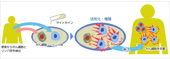 「自己腫瘍・組織を用いた活性化自己リンパ球移入療法」の模式図