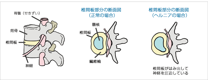 背骨と椎間板