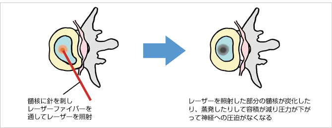 椎間板を焼いてヘルニアを引っ込める 経皮的レーザー椎間板減圧術 医学 医療最前線 先進医療 Net