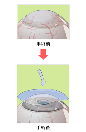 羊膜移植の図
