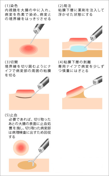 が 視 大腸 ん 鏡 手術 内