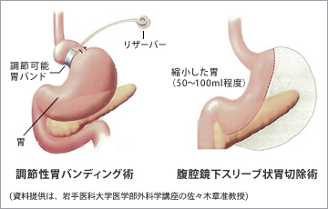 図2●岩手医科大学附属病院における腹腔鏡下減量手術