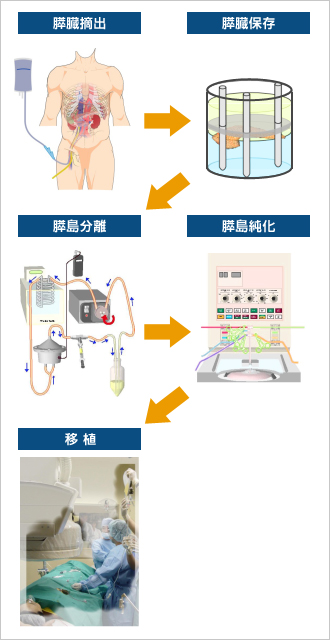 膵島分離・移植の手順