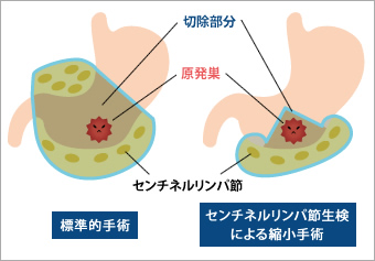 図2●標準的手術とセンチネルリンパ節生検による縮小手術の違い