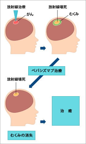 図1●脳放射線壊死によって生じた浮腫に対するべバシズマブ治療