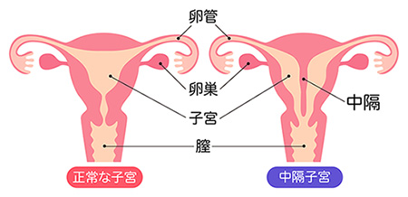 子宮の先天異常