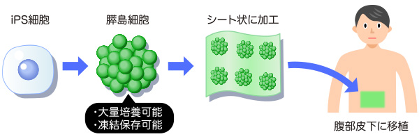 iPS細胞から作った膵島細胞をシートにして移植