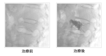 左は骨セメントを注入する前の写真。右は手術した後の写真。注入したセメントは黒く映っている。（写真提供：聖マリアンナ医科大学病院滝澤謙治教授）