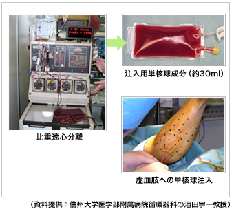 写真１：患者の手術際で骨髄単核球を分離