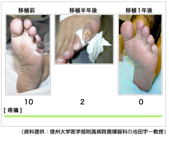 写真２：移植後1年で壊疽が寛解