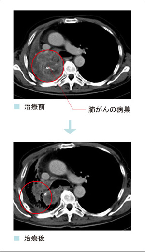 樹状細胞ワクチン療法による肺がんの治療例。治療後の写真では、肺がんの病巣が小さくなっているのが分かる