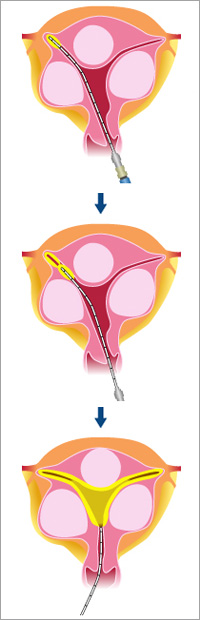 「サウンディングアプリケーター」により子宮筋腫を凝固させる様子（出典：医誠会病院レディスセンター・金岡靖センター長監修、アルフレッサファーマ株式会社「マイクロ波による過多月経の治療法」）