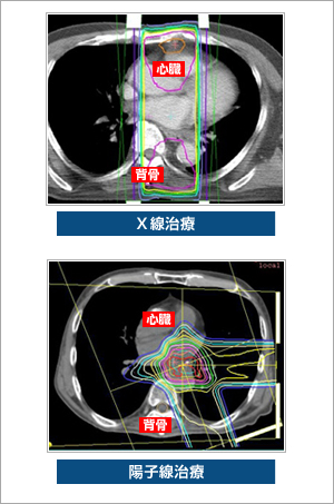 図2●食道がんに対する線量分布の違い