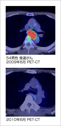 進行食道がんの症例