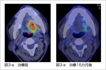 舌がんに対する陽子線治療と動注療法の併用療法