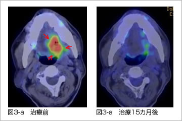 舌がんに対する陽子線治療と動注療法の併用療法