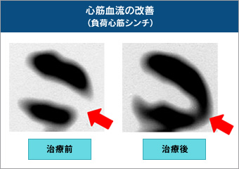 図3●血流が改善する様子