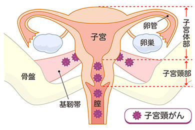 お腹を切らずに 子宮頸がんを取りきる腹腔鏡下広汎子宮全摘術 先進医療の現場から 先進医療 Net