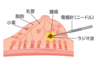 小さな乳がんに メスを入れない 選択肢 経皮的乳がんラジオ波焼灼療法 先進医療の現場から 先進医療 Net