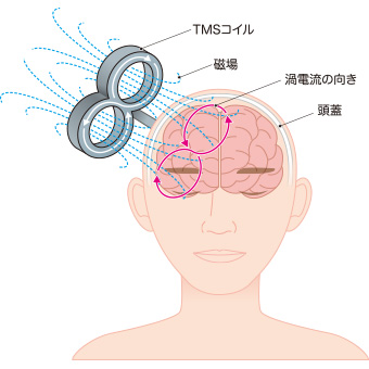 rTMSの仕組み