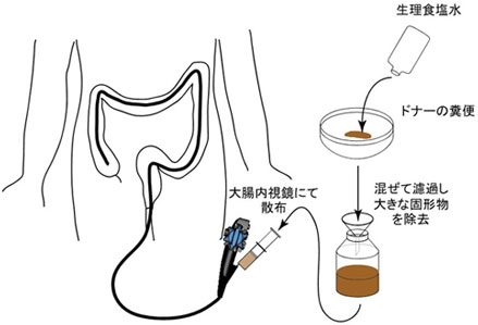 ドナーの微生物叢を移植して腸内細菌のバランスを取り戻す