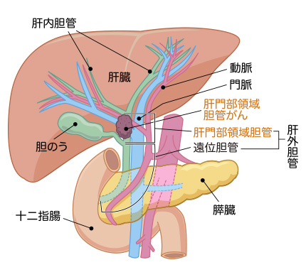 肝門部領域胆管がん