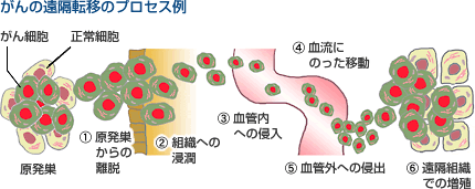がんの遠隔転移のプロセス例