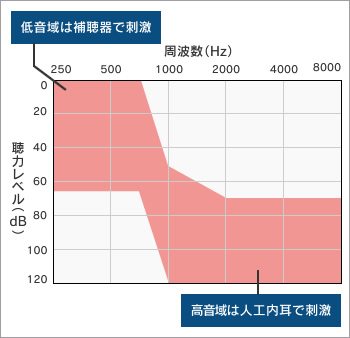 図2●残存聴力活用型人工内耳の適応基準聴力
