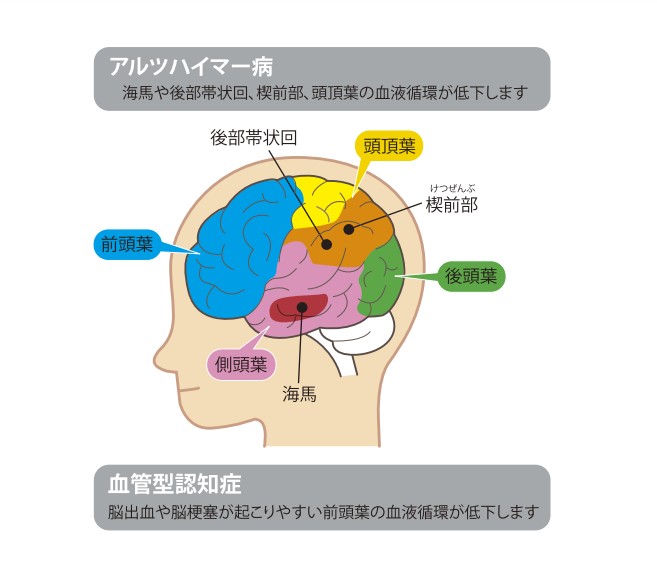 認知症による異常が現れる部分の違い