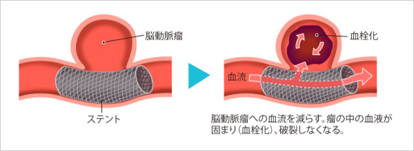 広がる脳血管内治療の進歩と課題 脳卒中の今 先進医療 Net