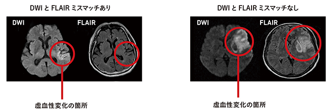 脳卒中治療ガイドライン2015［追補2019］」で変わる脳梗塞治療｜脳卒中 