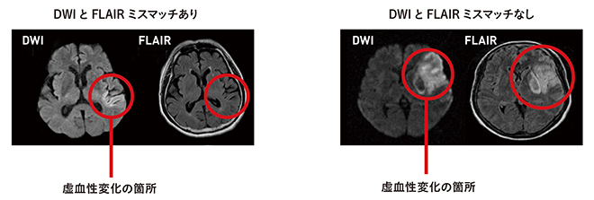 DWIとFLAIRのミスマッチの例