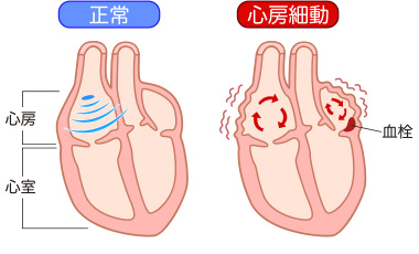 心房細動のイメージ